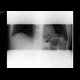 Small bowel ileus: X-ray - Plain radiograph